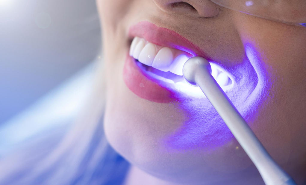 Профессиональная гигиена и отбеливание